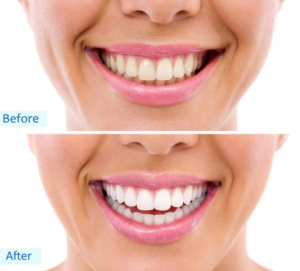 Before and after Zoom teeth whitening