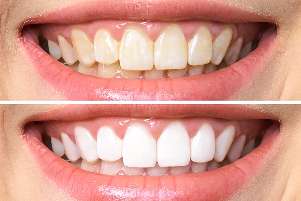 Zoom teeth whitening process at Aries Clinic