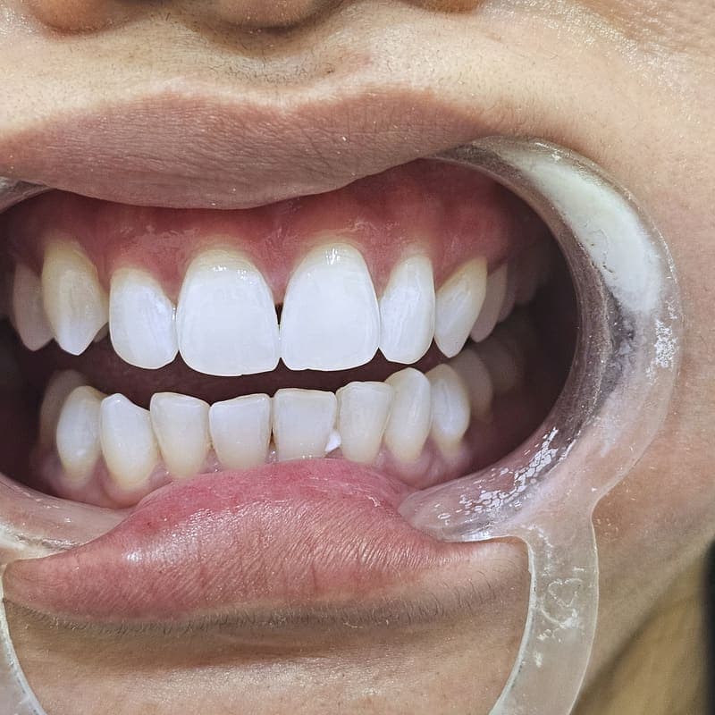 Zoom teeth whitening patient 1 after