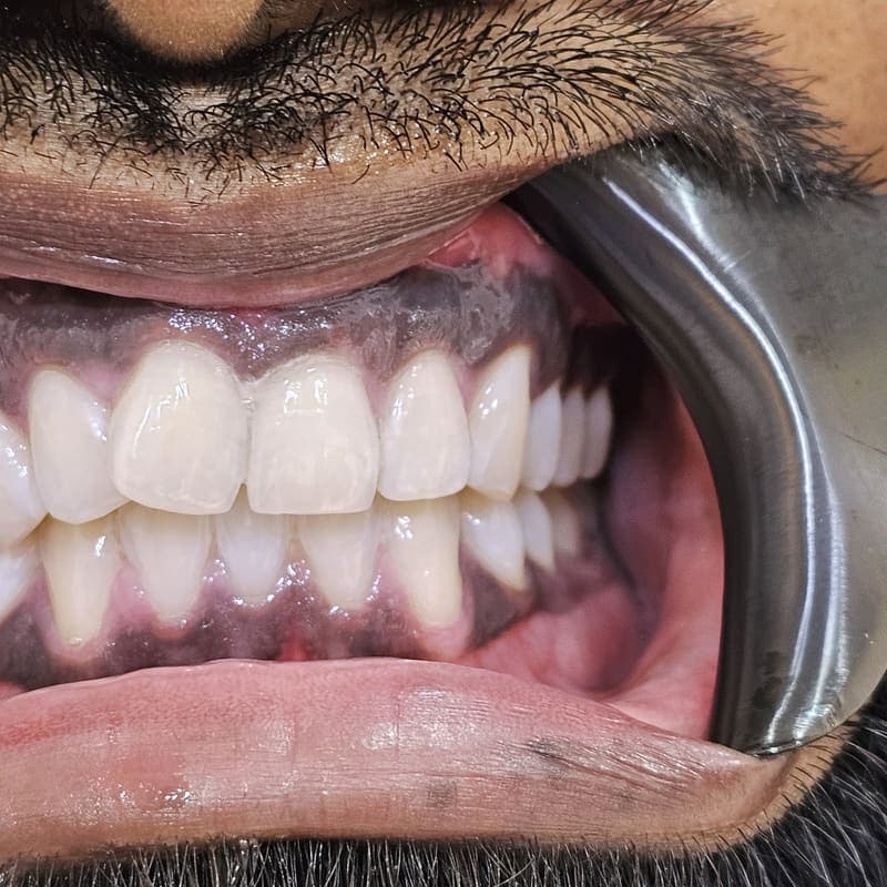 Zoom teeth whitening patient 2 after