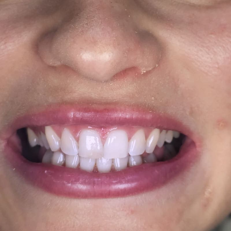 Zoom teeth whitening patient 3 after