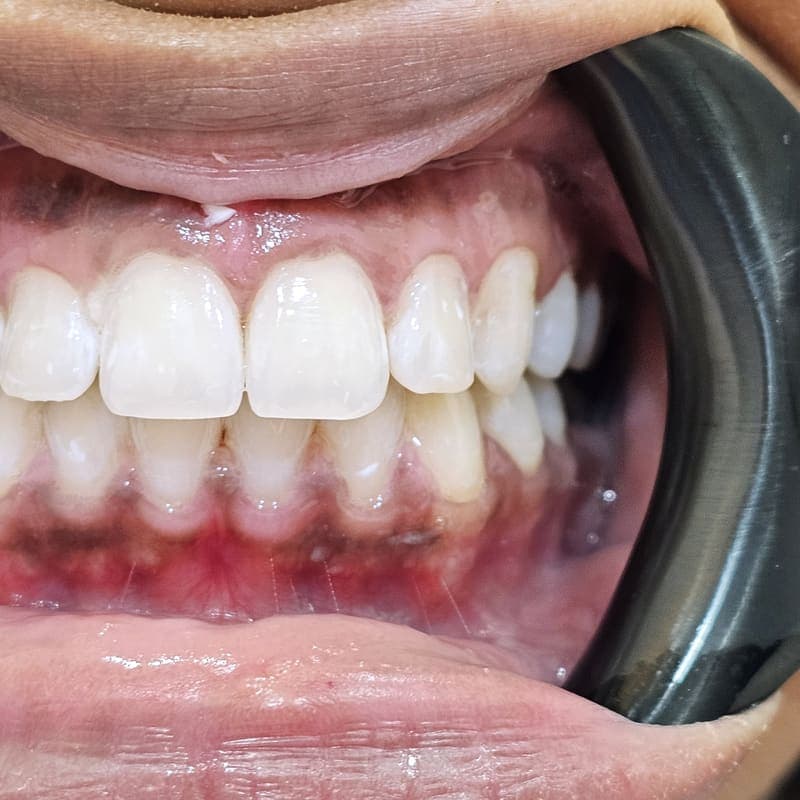 Zoom teeth whitening patient 4 after