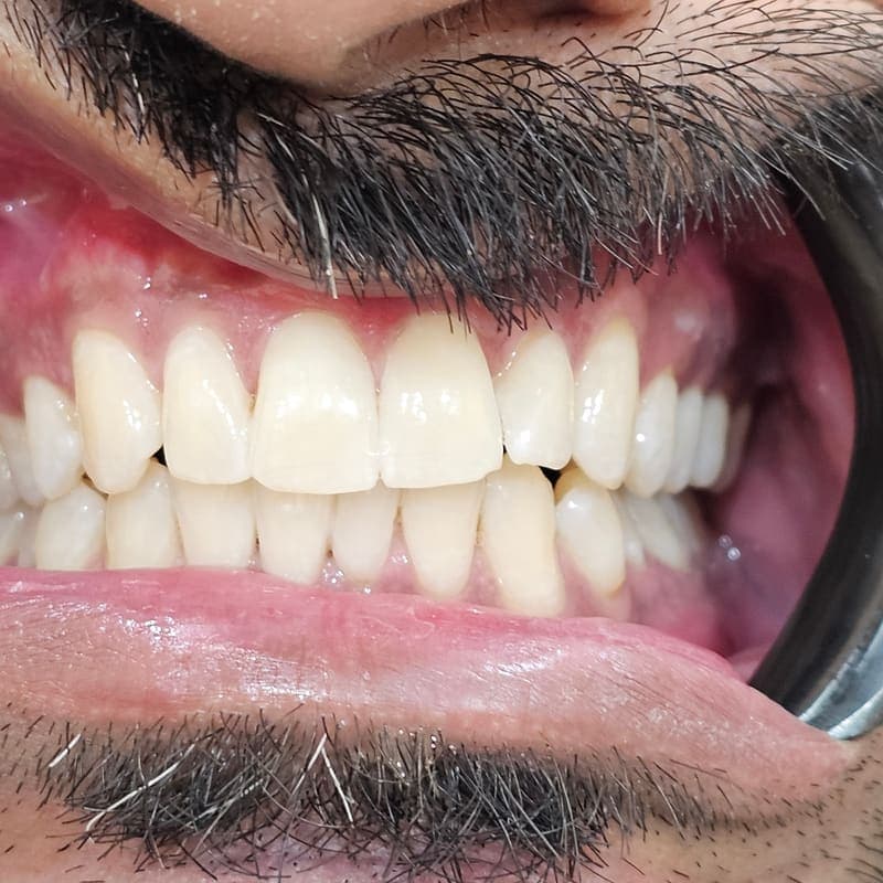 Zoom teeth whitening patient 5 after