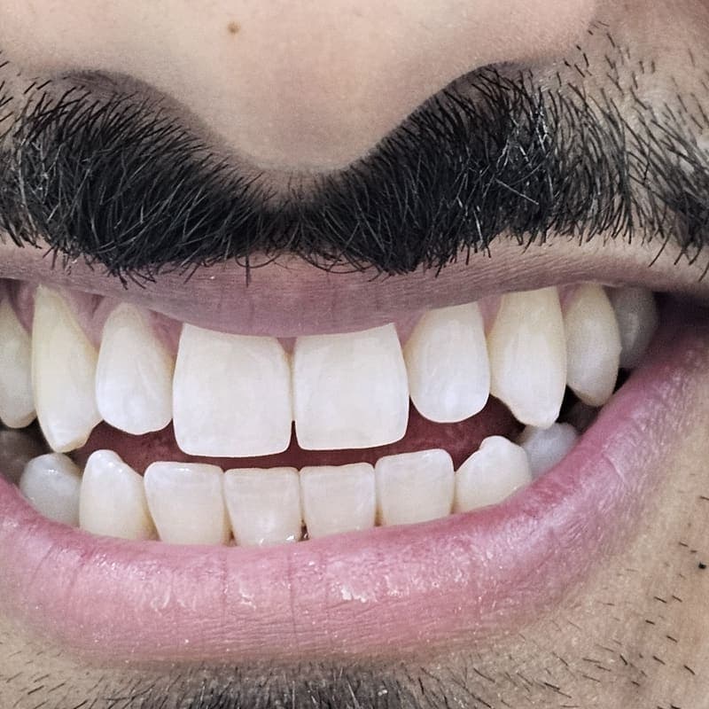Zoom teeth whitening patient 6 after