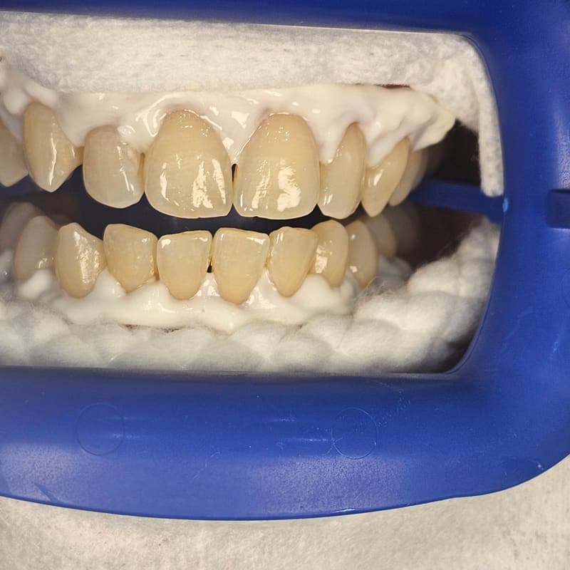 Zoom teeth whitening patient 1 before