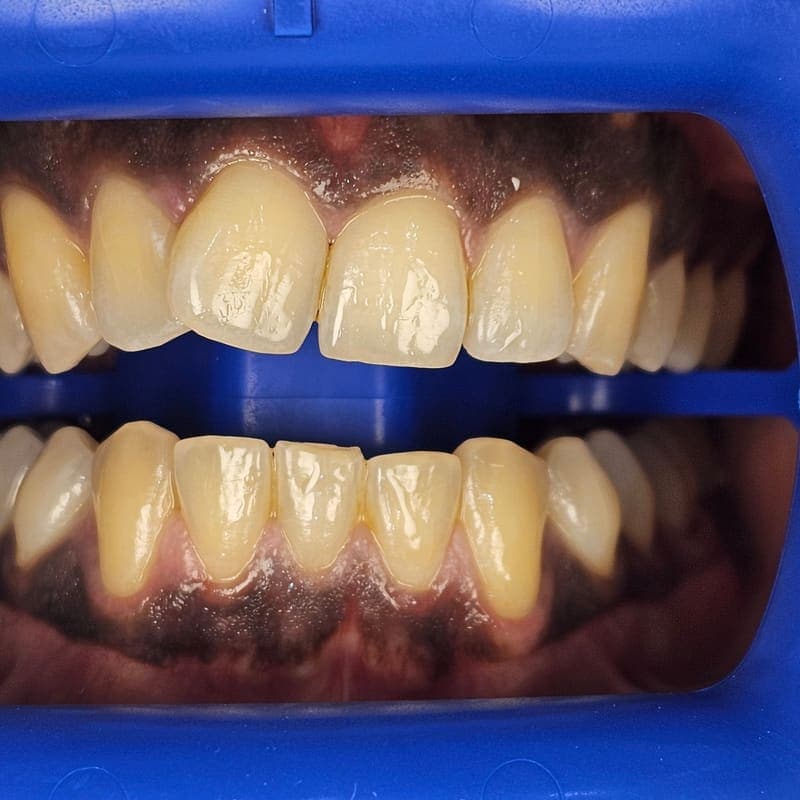 Zoom teeth whitening patient 2 before