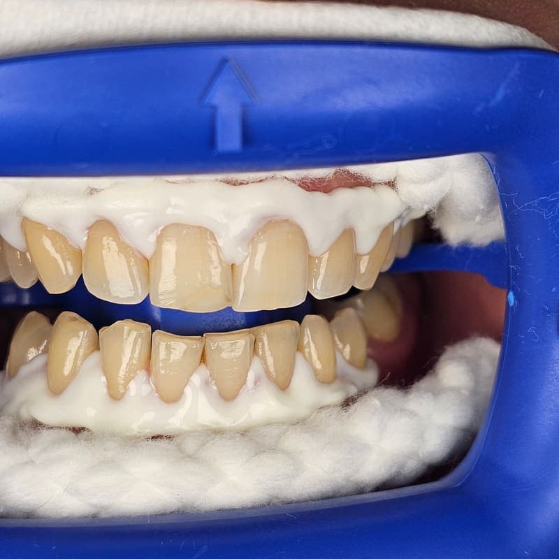 Zoom teeth whitening patient 3 before