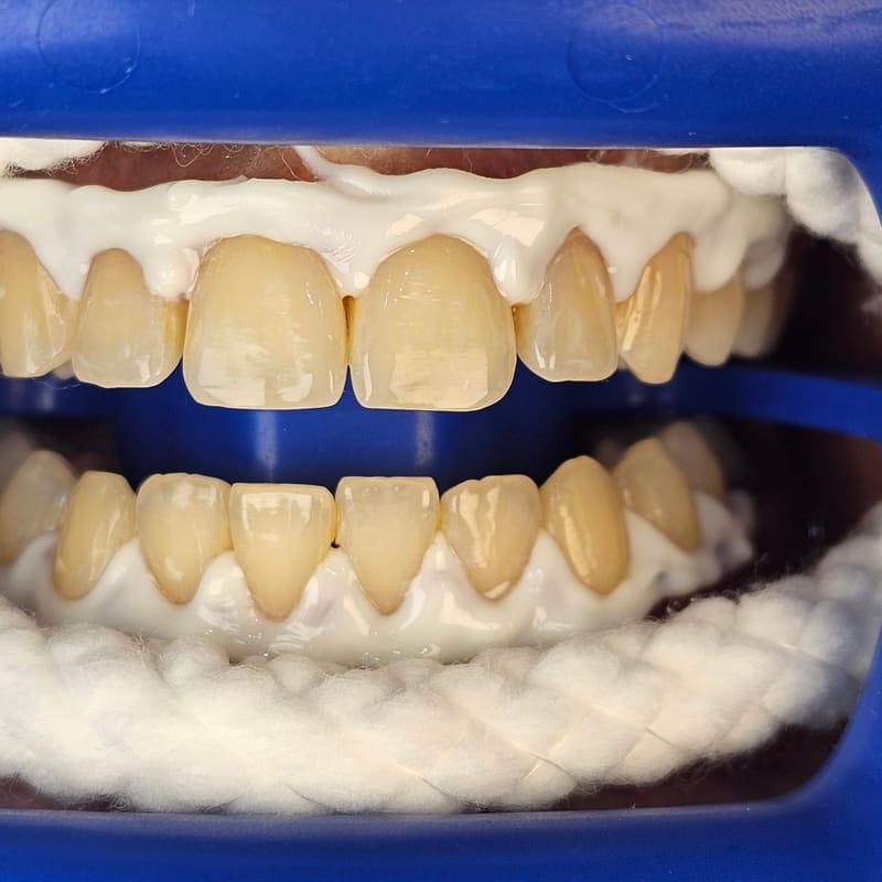 Zoom teeth whitening patient 4 before