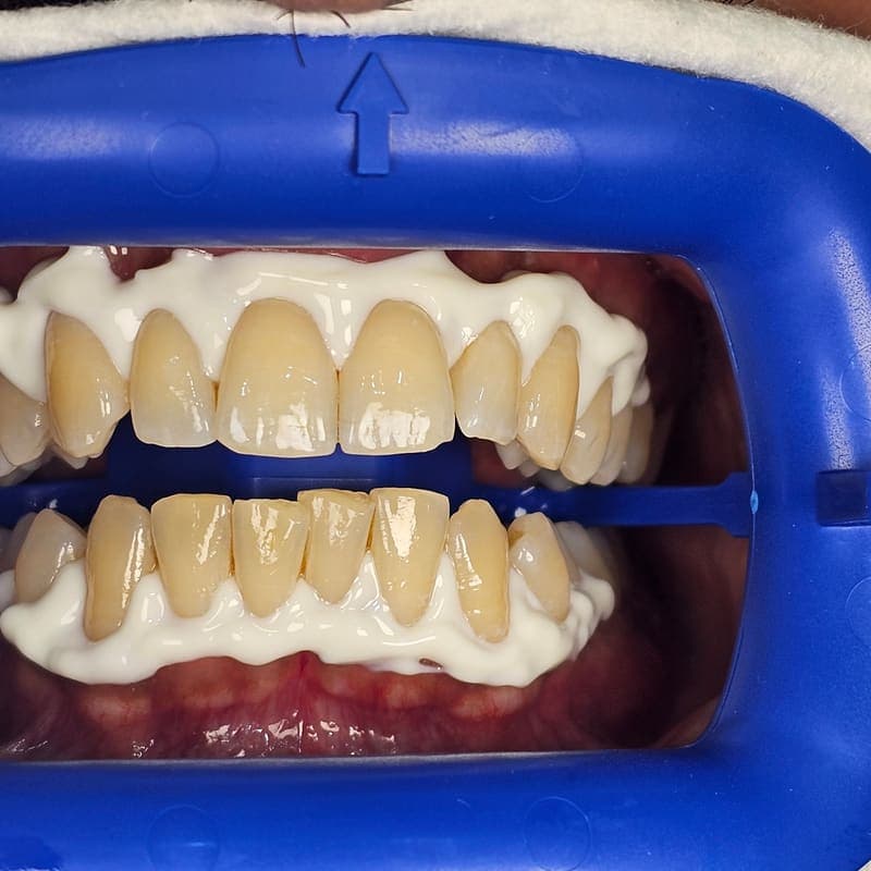 Zoom teeth whitening patient 5 before