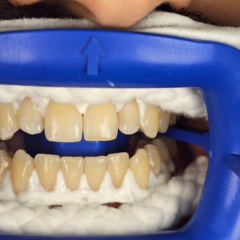 Zoom teeth whitening patient 6 before