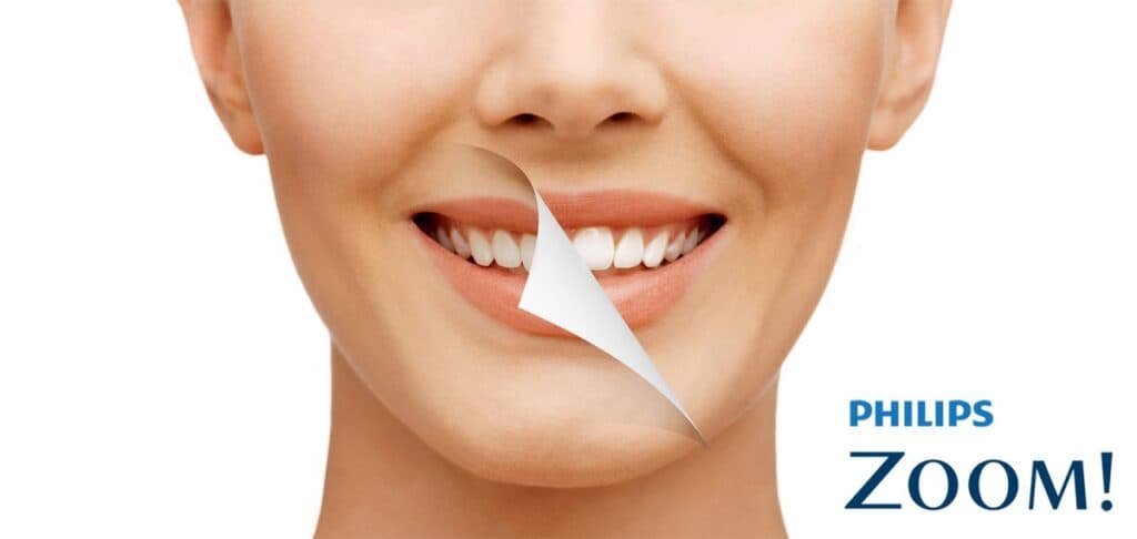 Philips Zoom teeth whitening